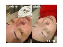 #美容革命ラボ 福岡春吉店/くすみ赤み【春吉・天神・博多】