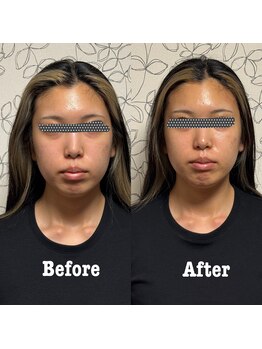 プレシャス(Precious)/EMS効果で顔の輪郭がスッキリ