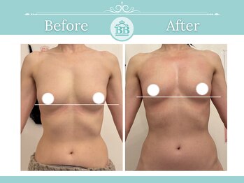 美人バスト つくば店/【バストアップ/育乳 症例】