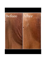 アウローラ 大田原店(AVRORA)/たるみや黒ずみにも効果大♪