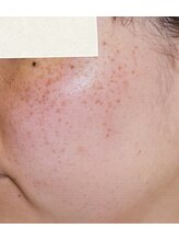 サロンドカイ(Salon de Kai)/肌育成プログラム　初回