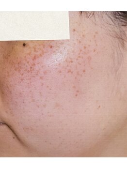 サロンドカイ(Salon de Kai)/肌育成プログラム 初回