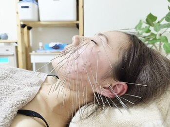 きやま鍼灸治療院の写真/【芸能人ご用達】施術後の違いに感動！知る人ぞ知る太くて長い「ルート美容鍼」で最高の小顔効果を◎