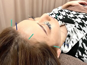 キャンディ鍼灸整骨院の写真/≪スッキリ小顔★電気美容鍼¥4000≫むくみやリフトアップにおすすめの美容鍼に電気を流すことで速攻実感◎