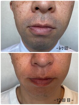 ソウ(SOU)/メンズ・ヒゲ脱毛