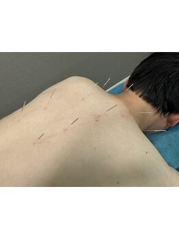 鍼灸施術を受けたい