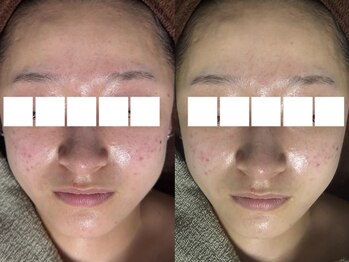 リボーン(REBORN)/ハーブピーリング