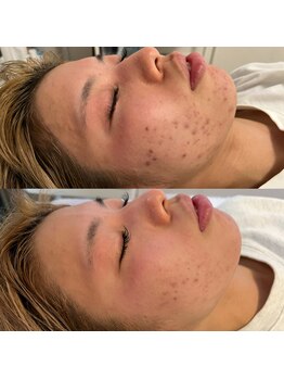 リリアス(RILLIAS)/肌トラブル跡ケア