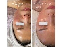 リュミエール(Lumie're)/美白、美白ピーリング