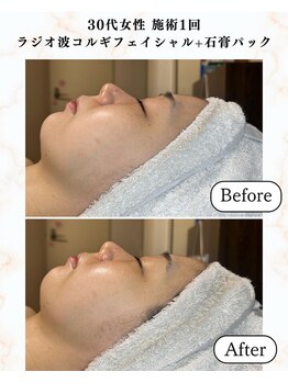 シーフェイス 横浜店(SEE FACE)/ラジオ波小顔コルギフェイシャル