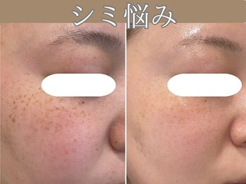 ハウオリ(HAUOLI)/シミ改善