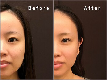 うぃず鍼灸整骨院の写真/協会認定の美容鍼｜むくみ・たるみにアプローチし印象すっきり美しく整えます◎小顔/フェイスライン/むくみ