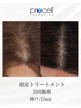 ユミト(Umit)/プロセルスカルプ