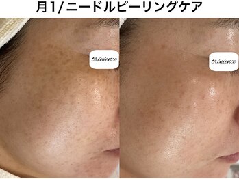 トリニエンス 南流山店/40代/艶肌/ハリ/リフトケア