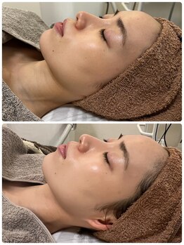 ジェニー(JENNI)/エクソソーム×LDM