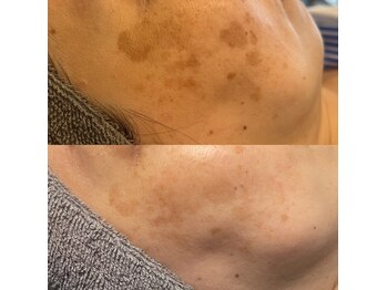 モルセラ(Moluccella)/15回の施術