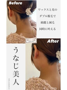 エリス(ELISSE)/ワックスと光のダブル脱毛
