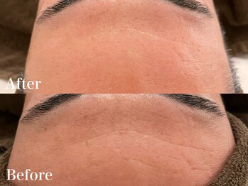 シャルム(Charme)/メンズフェイシャル♪シワケア