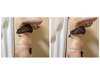 スリーピングビューティー(Sleeping Beauty)/インディバ　二の腕引き締め