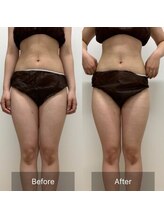 ルセヴィア(LUCEVIA)/痩身エステ（半身/下半身）