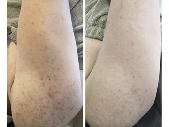 モカ 天王寺店(MOKA)/剥離3回　二の腕　ブツブツ