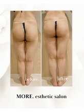 モア 恵比寿(MORE.)/1回での効果！むくみ・セル撃退