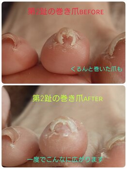 フットスタジオ アルク(FOOT STUDIO ALUK)/【第2指の巻き爪補正】