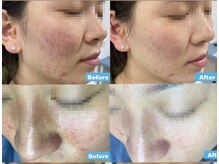 マグノリア(MAGNOLIA)の雰囲気（肌育ピーリングは回数を重ねるとお肌が強くなります。）