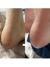 ビビィ(vivie)/ガサガサかかと、お任せください