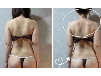 スリーピングビューティー(Sleeping Beauty)/インディバ　肩の盛り上がり改善