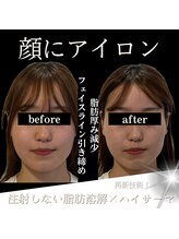 クリニカルボーテ 心斎橋院(CLINICAL BEAUTE)/ほうれい線ができる前から！