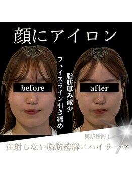 クリニカルボーテ 心斎橋院(CLINICAL BEAUTE)/ほうれい線ができる前から！