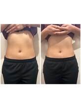 池袋東口整体院/【ビフォーアフター5】痩身