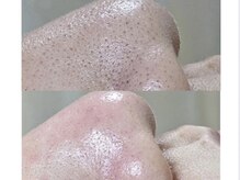 タン(TAN)の雰囲気(毛穴の黒ずみ.詰まりを徹底除去し艶のあるお肌へ)