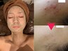 敏感肌・角質除去で憧れの水光肌へ♪ハーブピーリングプレミアム☆60分6600円