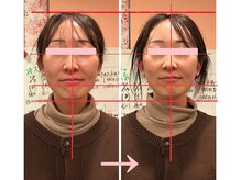 はあとの雰囲気（小顔調整1回の変化。一回り小さくなりお肌もトーンアップ☆）