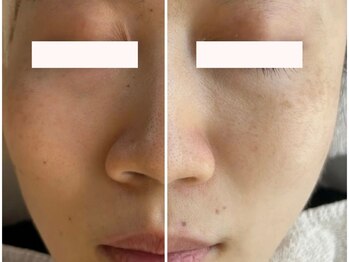 フェスティナ レンテ(Festina Lente)の写真/くすみ改善！肌トーンUP効果◎≪特殊スパイラルチップ×美容液≫トルネード毛穴洗浄*最新ハイドロスキン