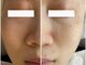 フェスティナ レンテ(Festina Lente)の写真/くすみ改善！肌トーンUP効果◎≪特殊スパイラルチップ×美容液≫トルネード毛穴洗浄*最新ハイドロスキン