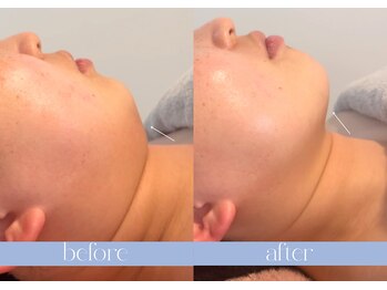 ステラ(STELLA)/二重顎もスッキリ!超小顔術♪