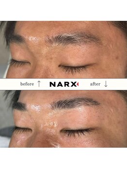 ナークス(NARX)/【眉毛脱毛】ビフォーアフター