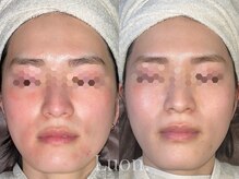 ルオン(Luon.)/乳酸菌ピーリング/6回