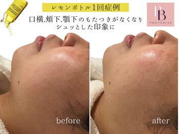 フォトビズ/二重顎たるみもたつき改善