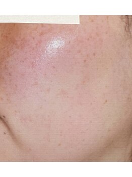 サロンドカイ(Salon de Kai)/肌育成プログラム 半年