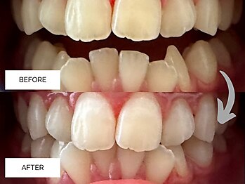 リンネ(Rin'ne)/[ホワイトニング] 15分×2回照射