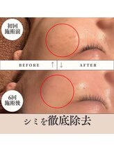 ラリリー(La Lily)/シミ改善！肌荒れにも効果◎