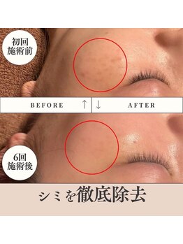 ラリリー(La Lily)/シミ改善!肌荒れにも効果◎