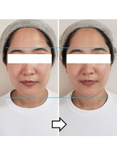 きしの美容整体院/フェイシャルリフトケアBA