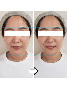 きしの美容整体院/フェイシャルリフトケアBA