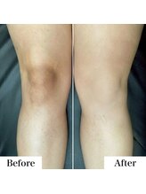 ルネル(Lunelle)/韓国式メラニンケア《膝》