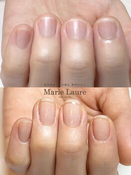 マリーロール 梅田店(Marie Laure)/自爪育成/深爪矯正/ネイルケア